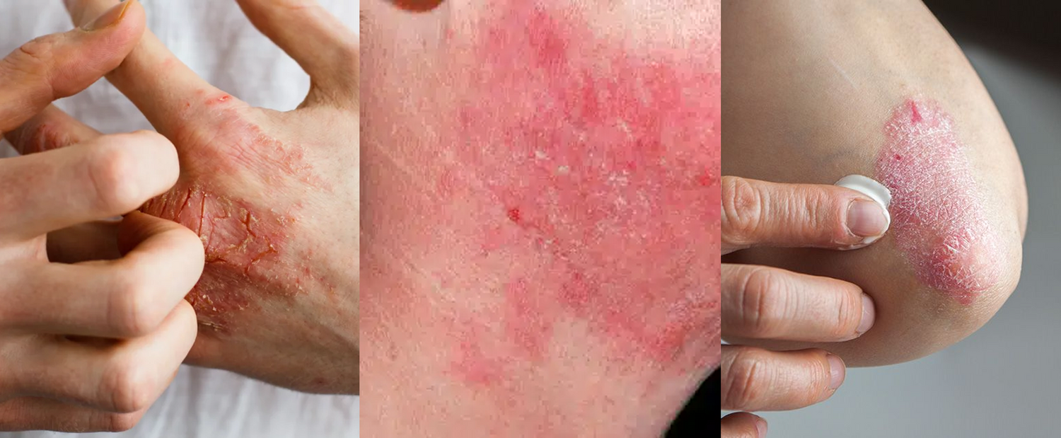 5 Surprising Reasons People Are Switching from Steroid Creams to Tallow for Eczema Relief