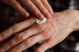 Why More People Are Turning to Beef Tallow for Eczema Relief